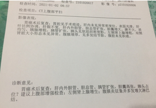胃癌术后复发
